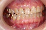 オールセラミクスクラウン上顎右上側切歯2-1