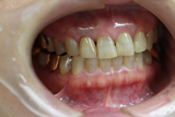 オールセラミクスクラウン上顎右上側切歯2-1
