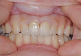 オールセラミクスクラウン上顎中切歯2-2