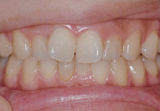 オールセラミクススラウン上顎中切歯2-1