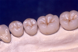 メタルボンド臼歯