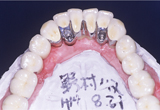下顎インプラントフルマウス9-2